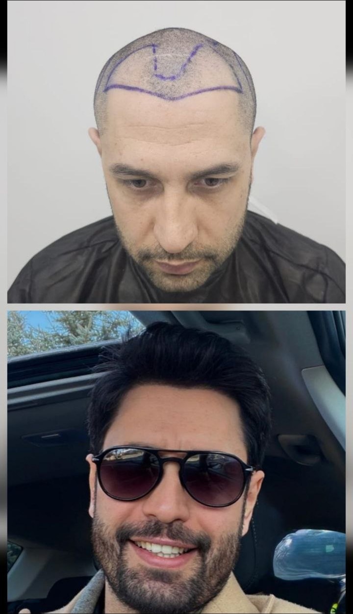 Saç ekimi öncesi ve sonrası — vaka 3