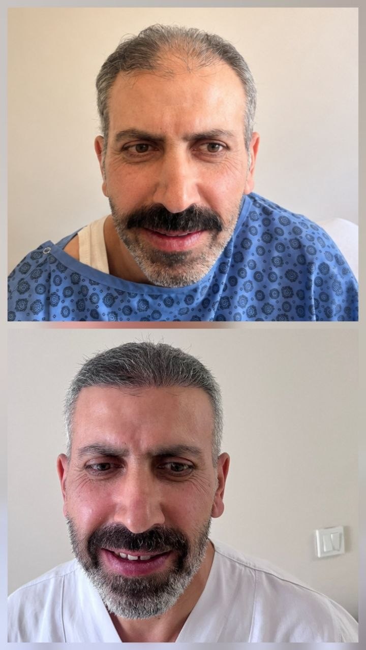 Saç ekimi öncesi ve sonrası — vaka 2