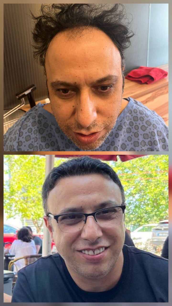 Saç ekimi öncesi ve sonrası — vaka 8
