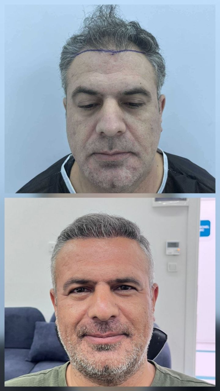 Saç ekimi öncesi ve sonrası — vaka 3