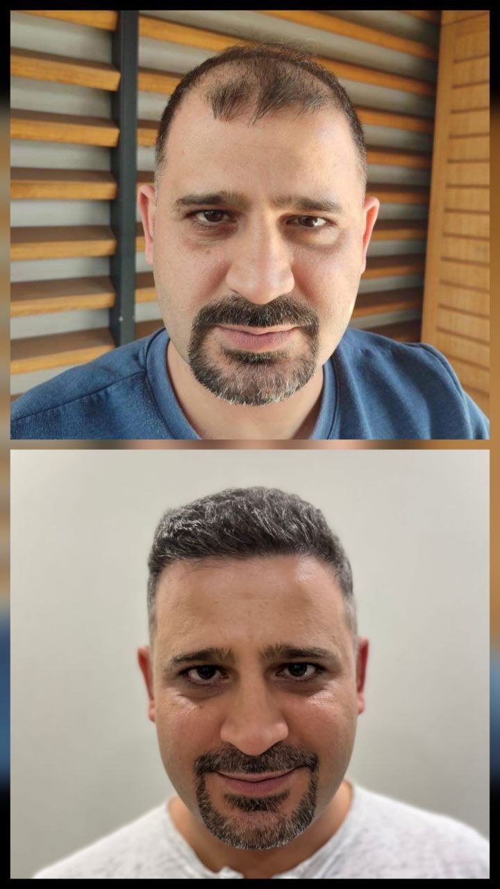 Saç ekimi öncesi ve sonrası — vaka 9