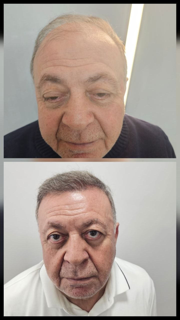 Saç ekimi öncesi ve sonrası — vaka 2