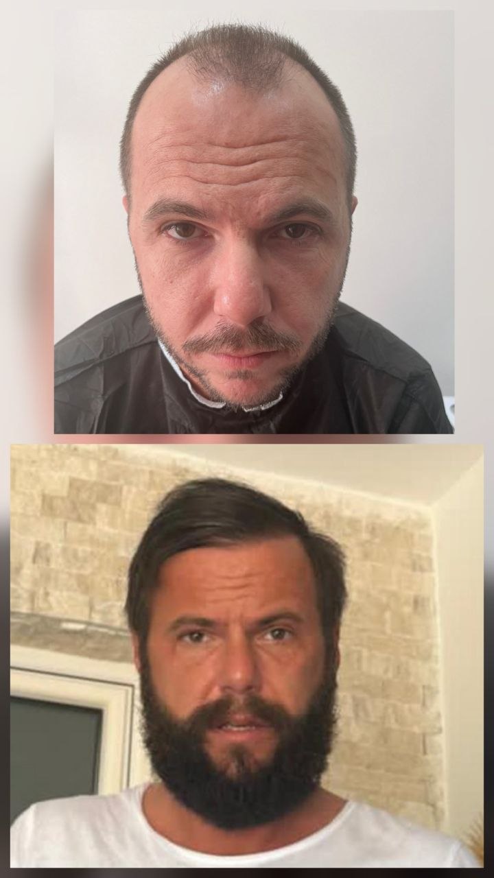 Saç ekimi öncesi ve sonrası — vaka 5